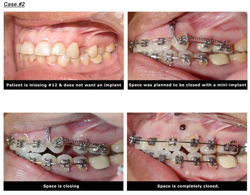 close space for missing tooth case 1 with mini implants temporary anchorage device TADS